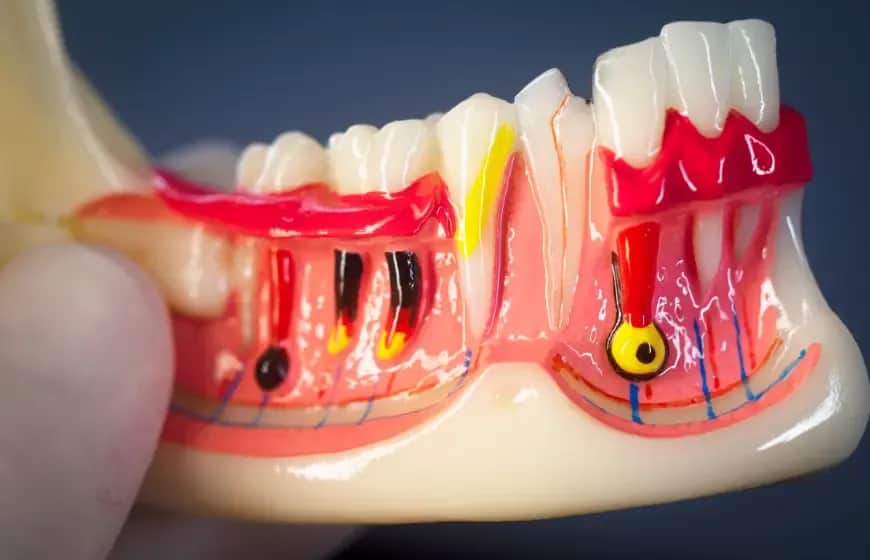 Ból wszystkich zębów naraz? Odkryj przyczyny i znajdź ulgę!