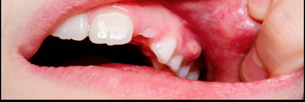 Ropień zęba: Jak złagodzić ból i skutecznie wyleczyć infekcję?