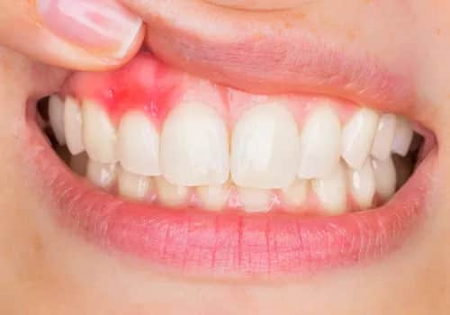 Boli Cię spuchnięte dziąsło? Szybka ulga i co dalej?