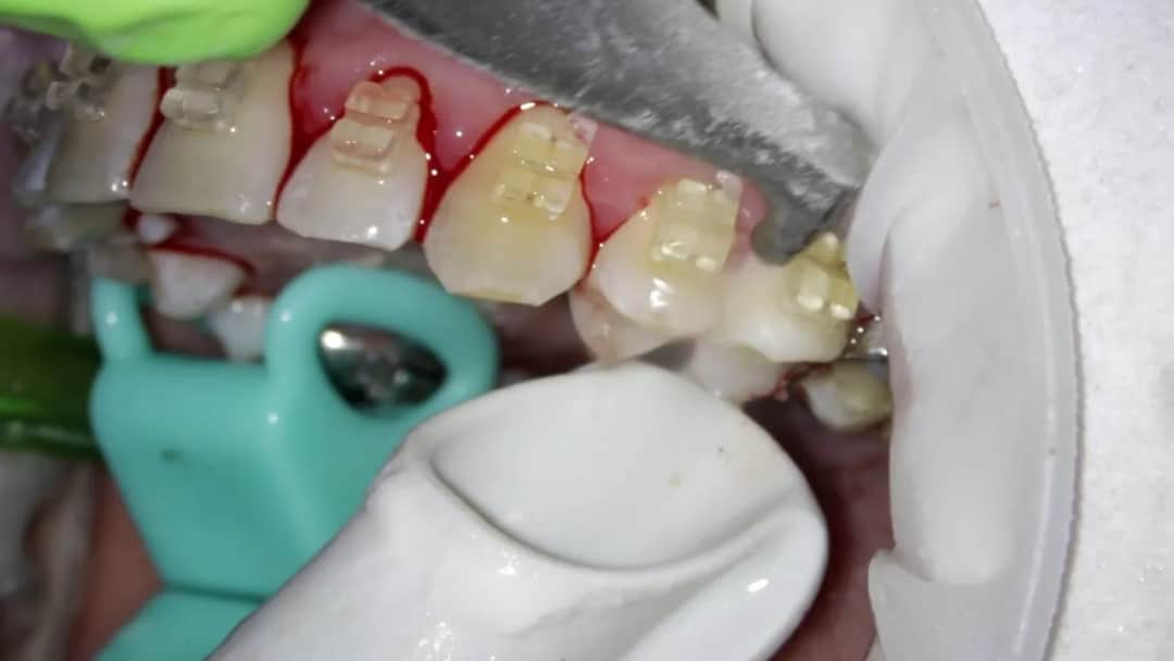 Piaskowanie zębów: Czy boli? Rozwiewam obawy i mówię, jak dbać!