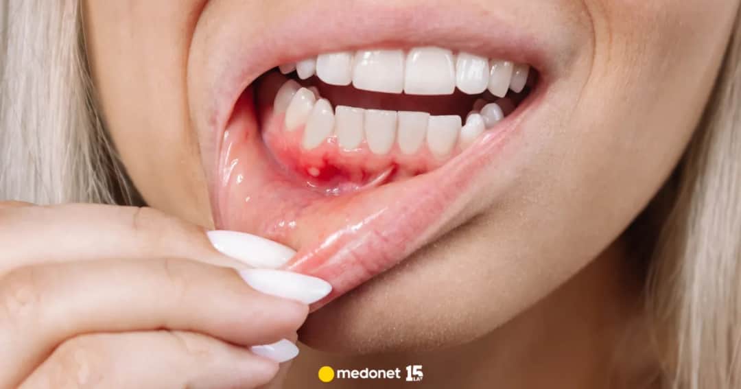 Bolące dziąsła? Szybka ulga i leczenie kiedy do dentysty?