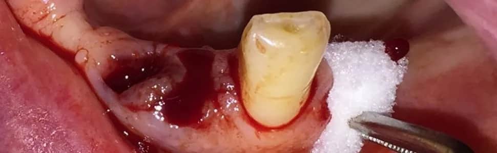 Krwawienie po wyrwaniu zęba: Czy to normalne? Poradnik eksperta