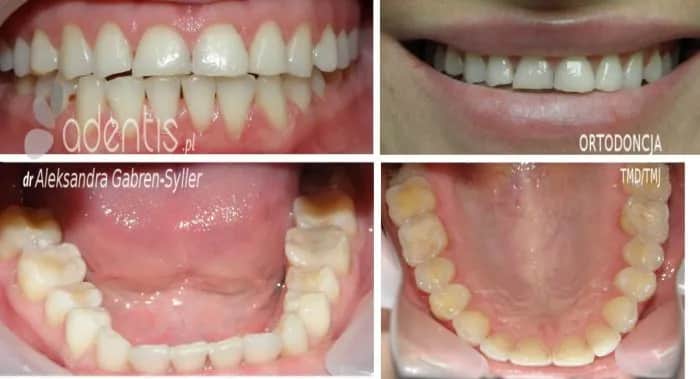Starte zęby: Jak skutecznie odbudować? Metody, koszty, profilaktyka.