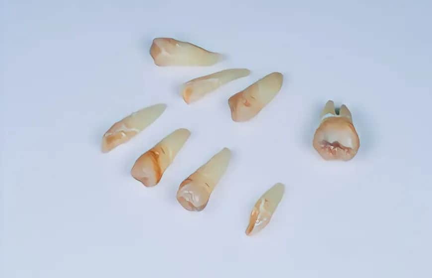 Ból po wyrwaniu ósemki: Jak długo? Kiedy do dentysty?