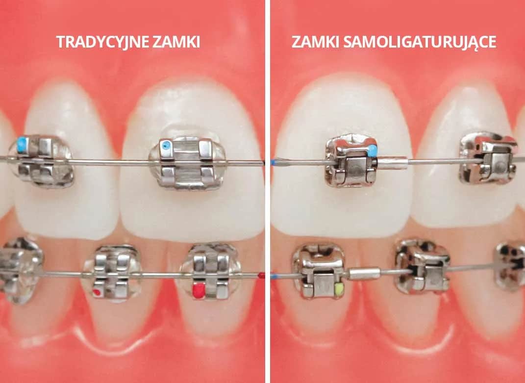 Ile trwa aparat na zęby? Czas leczenia i realne efekty
