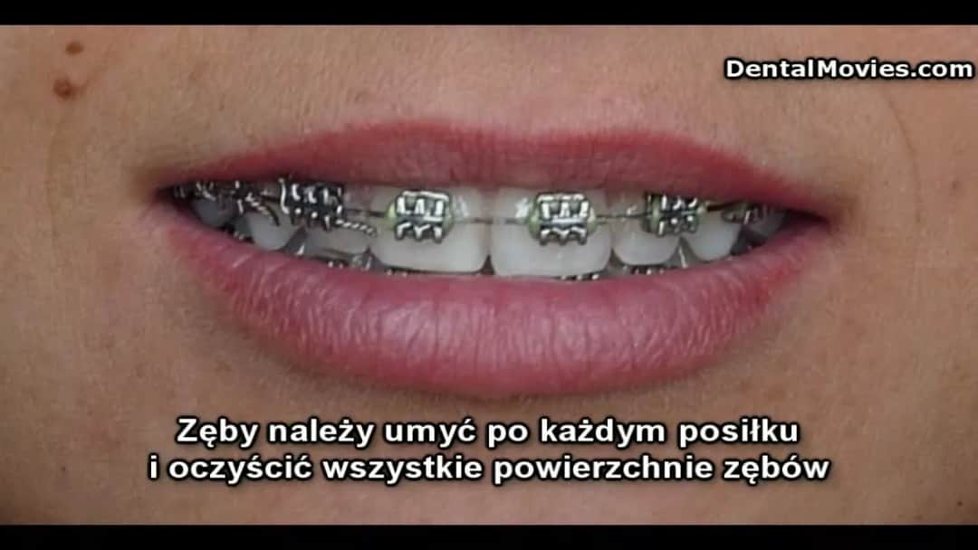 Ile trwa zakładanie aparatu i czy boli? Przewodnik ortodonty