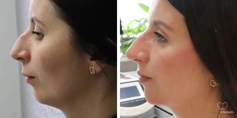 Aparat ortodontyczny a rysy twarzy: Odkryj, jak zmieni się Twój profil