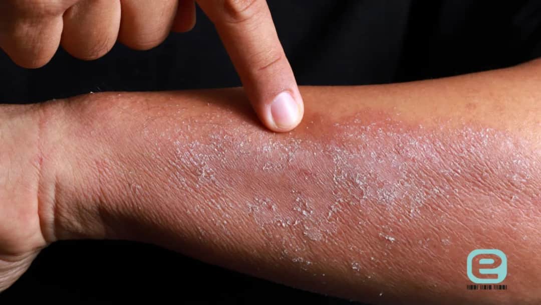 Alergia na nikiel w ustach? Rozpoznaj objawy i znajdź ulgę!