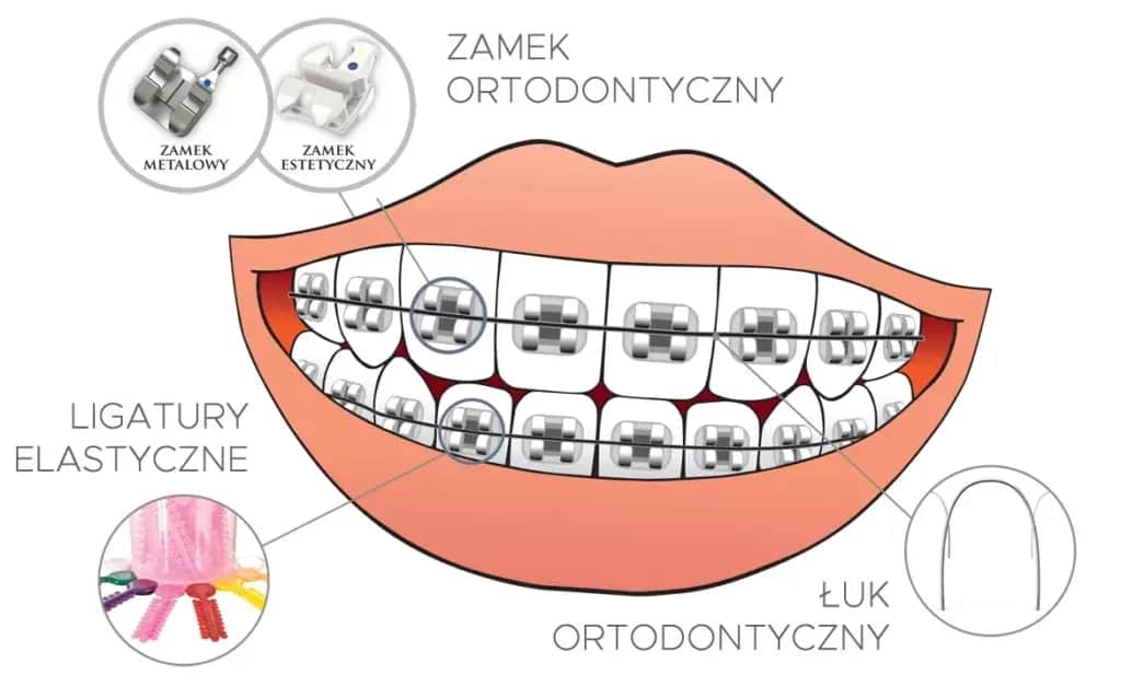 Kiedy założyć aparat na zęby? Wiek, warunki i proces krok po kroku