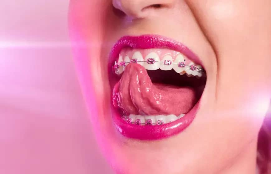 Jak wygląda aparat na zęby? Przewodnik po typach i estetyce