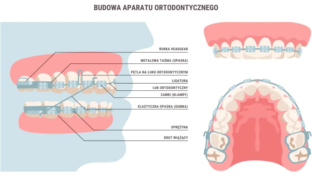 Aparat ortodontyczny: Ile trwa założenie i jak się przygotować?