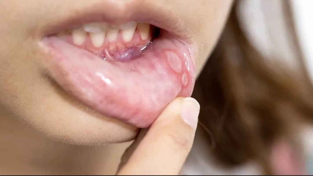 Bolesne rany w ustach? Znam szybkie sposoby na afty i ulgę!