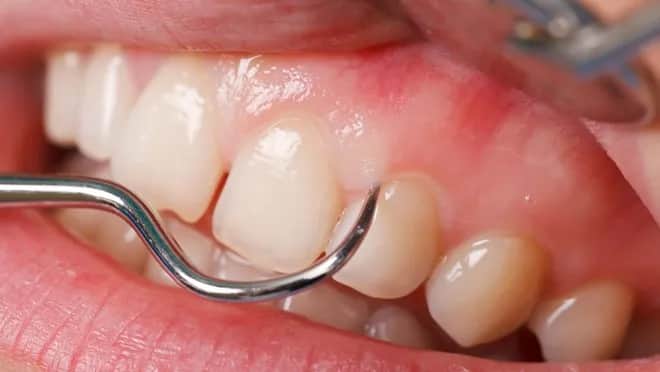 Boli dziąsło? Szybka ulga, przyczyny i kiedy musisz do dentysty.